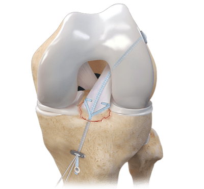 Tibial Spine Avulsion Repair