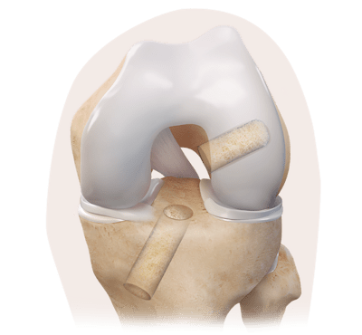 Revision ACL Reconstruction