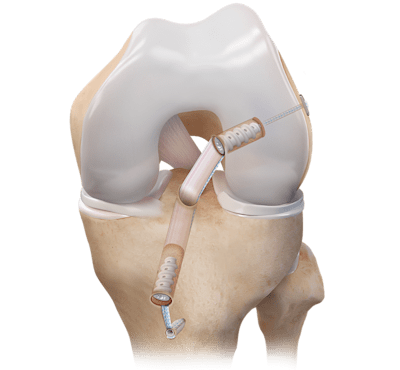 BTB Autograft ACL-Rekonstruktion