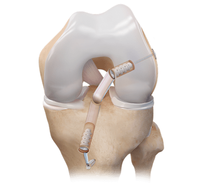 BTB Autograft ACL Reconstruction 