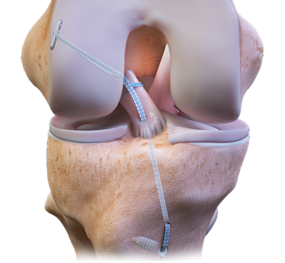 ACL Repair