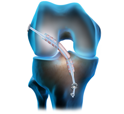 Quad Tendon Graft ACL Reconstruction