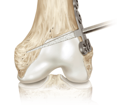 Preenchimento de orifício ósseo OSferion