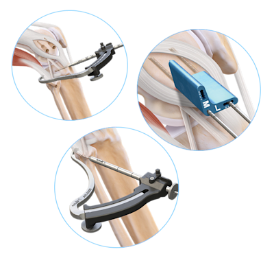 Reconstrucción anatómica de la esquina posterolateral y ligamentos colaterales