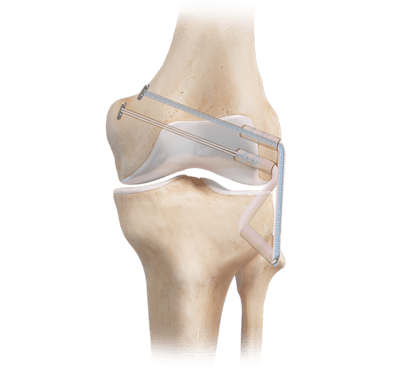 Fixação de enxerto no ligamento colateral