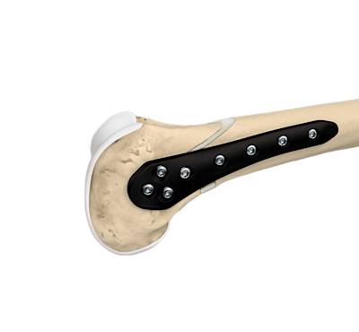 Distal Femoral Osteotomy