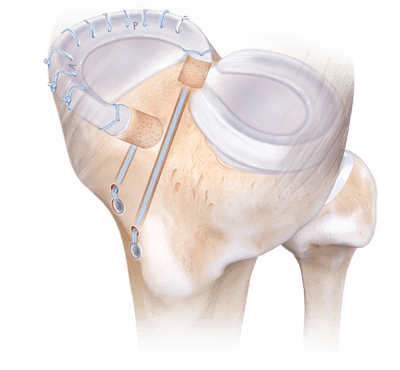 Transplante de meniscos con doble tapón óseo