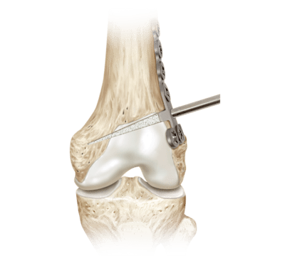 Osteotomía femoral distal