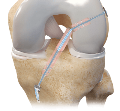 Autograft ACL-Rekonstruktion mit Hamstring