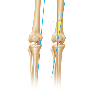 Limb Alignment Correction