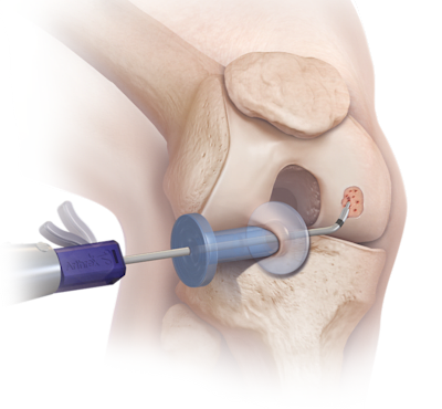 Microfracture