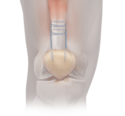 Tendon and Ligament Repair