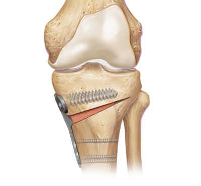 Cunha de abertura tibial