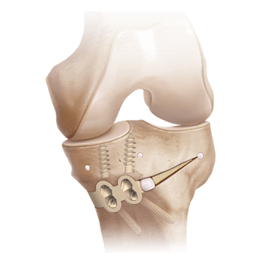 Osteotomía tibial proximal