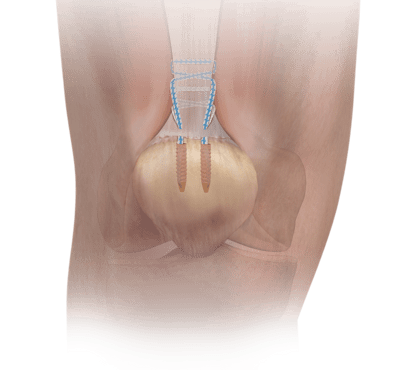 Die Technik für die Rekonstruktion der Quadrizepssehne mit dem perkutanen Achillessehnen- refixierungssystem