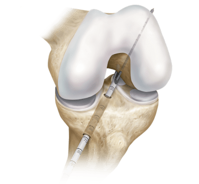 Reconstrução LCA transtibial