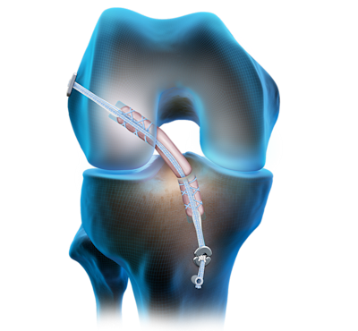 FiberTag®-TightRope® II-Implantat