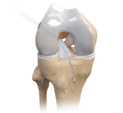 ACL Repair TightRope® Implant With FiberRing™ Sutures