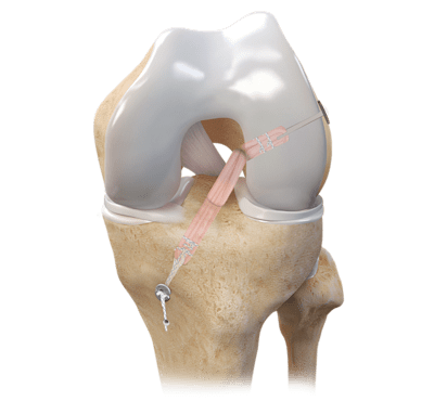 TightRope® II RT Implant