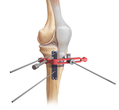 T3 AMZ-System für die Tuberositas tibiae