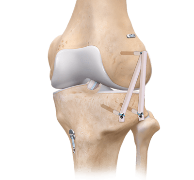Anterolateral Ligament Reconstruction