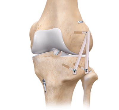 Reconstrução do ligamento anterolateral