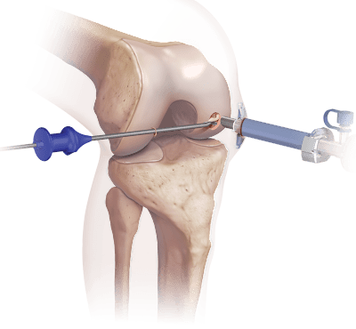 Extrazelluläre Matrix BioCartilage<sup>®</sup>