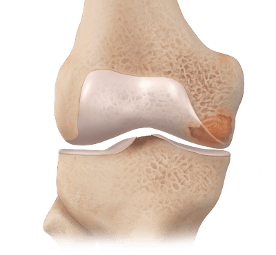 IntraOsseous BioPlasty® (IOBP®) Technique