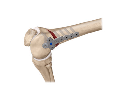 Placas y tornillos para osteotomía femoral distal ContourLock™