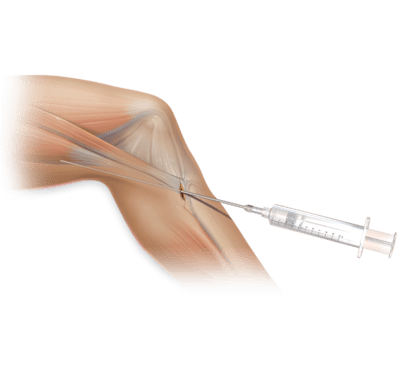 Tubo de administração anestesica para area de retirada dos isquiostibias