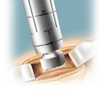 Bone Graft Harvester