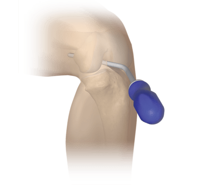 Obturador de rodilla para portales posteriores
