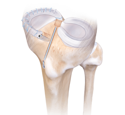 Meniscal Transplant Systems