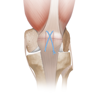 Patella Fracture System