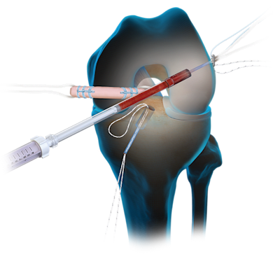 Die BioACL™-Technik