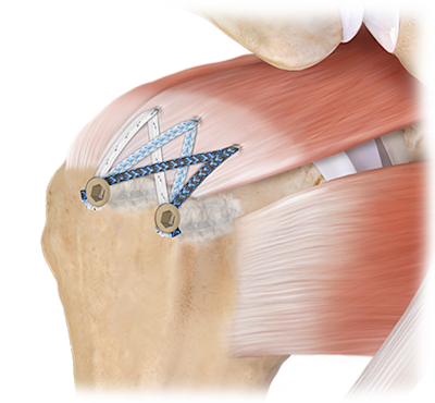 BoneSync™ Cement for Rotator Cuff Repair