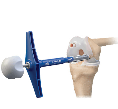 Autograft OATS® Technique for the Knee