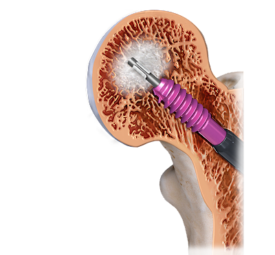 Trochanteric Nail Biologic Augmentation