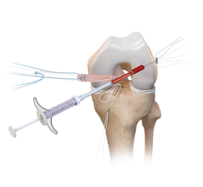 BioACL™ Technique