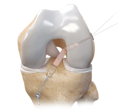 Allograft Tendons