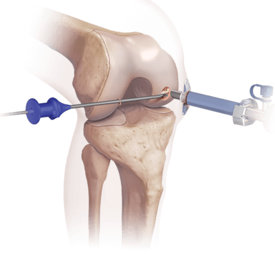 BioCartilage<sup>®</sup> Extracellular Matrix