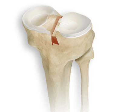 DoveTail-Meniskus-Allograft-Set