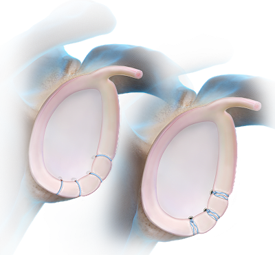 Anterior Labral Repair