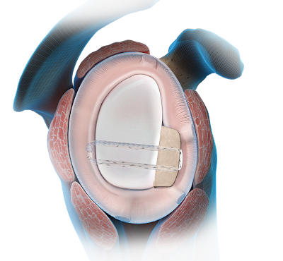Bone Block Cerclage