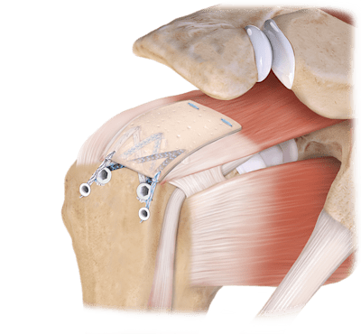 CuffMend™ Rotator Cuff Augmentation Technique