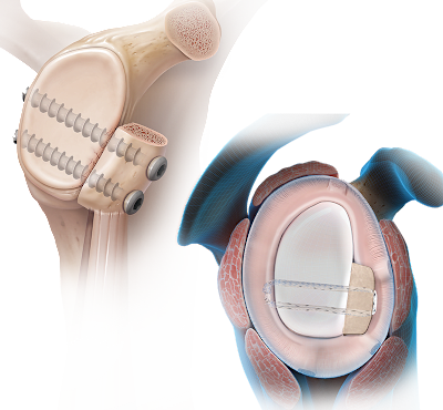 Glenoid Bone Loss