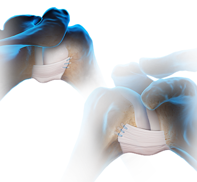 HAGL and RHAGL Lesion Repair