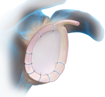 Knotless FiberTak® Soft Anchor Technique - MDI