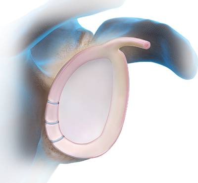 Knotless Fibertak® Soft Anchor Technique - Posterior