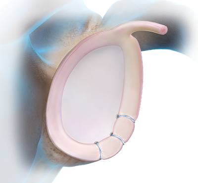 Knotless SutureTak® Anchor Technique - Anterior